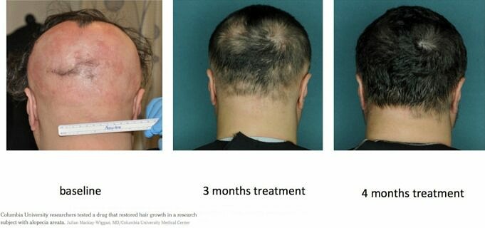 Alopecia Areata. Cause, Sintomi E Trattamenti