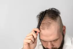 Altre opzioni di trattamento per la caduta dei capelli