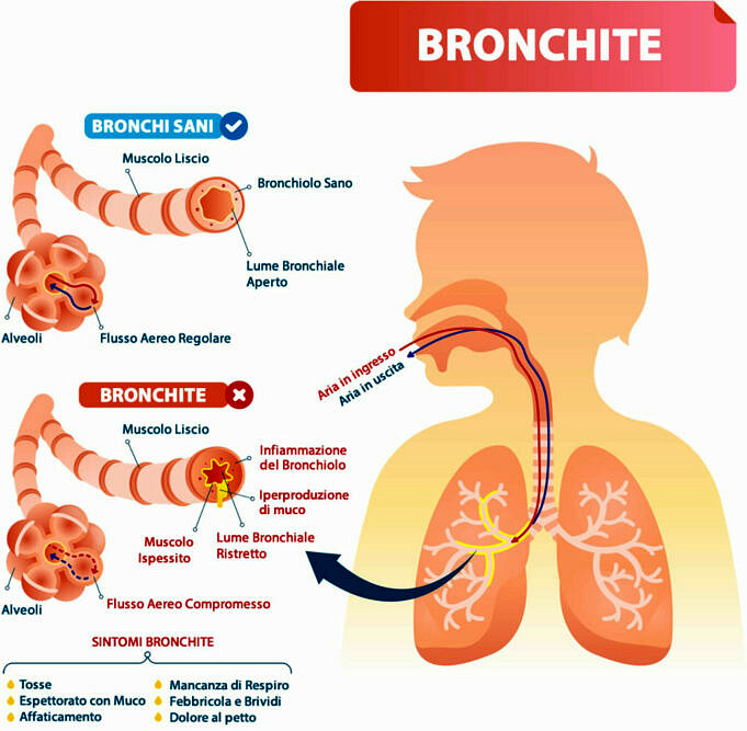 Bronchite. Sintomi, Cause E Trattamenti