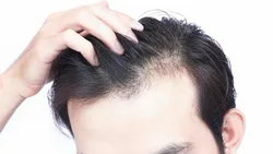 Vantaggi di consultare un medico per la perdita dei capelli